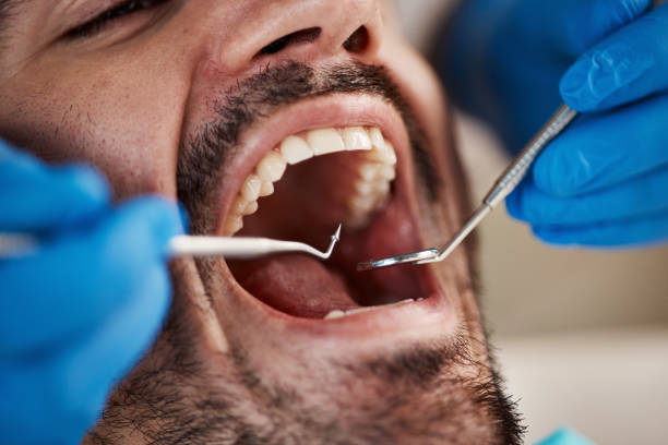 Best Emergency Tooth Extraction in Oswego, IL